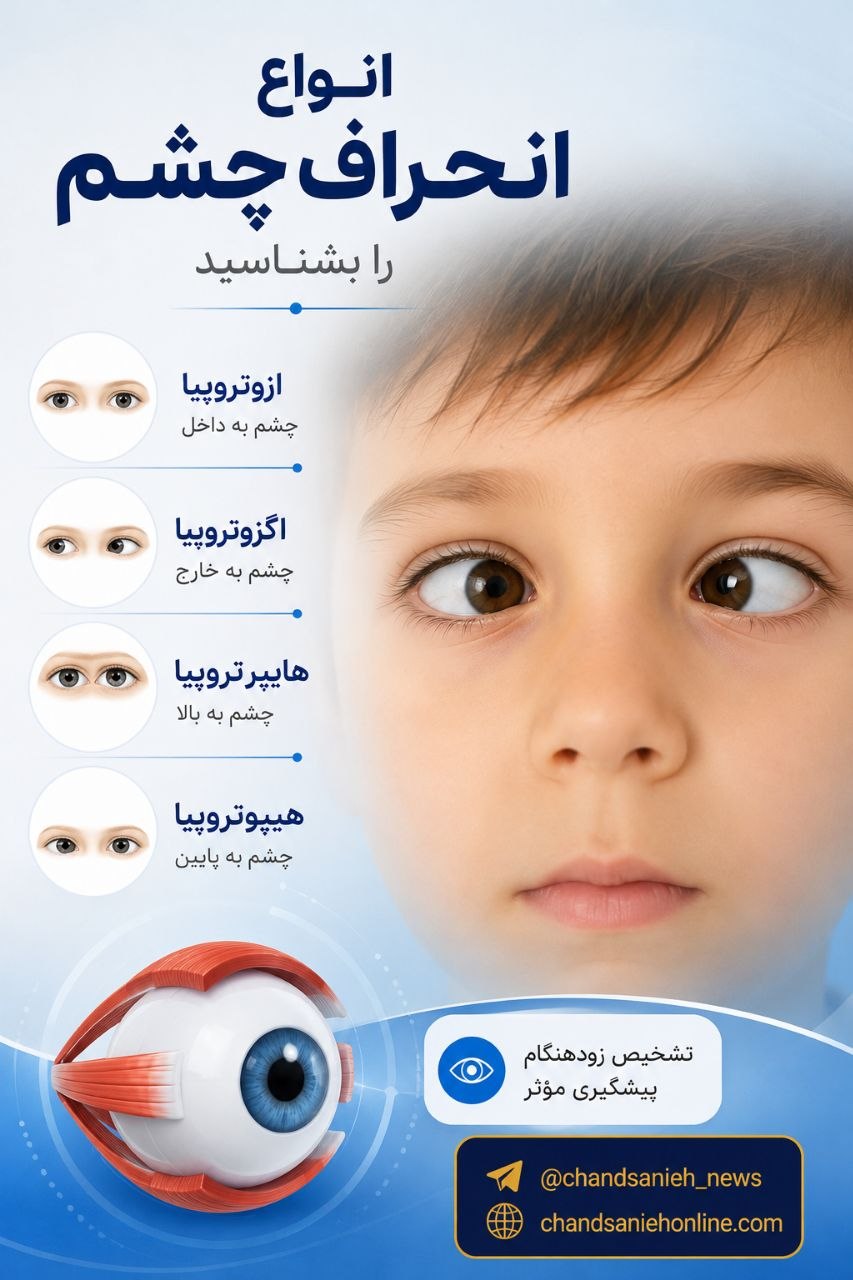 انحراف چشم