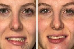 افتادگی ناگهانی صورت؛ نشانه‌ای که می‌تواند از سکته مغزی خبر دهد